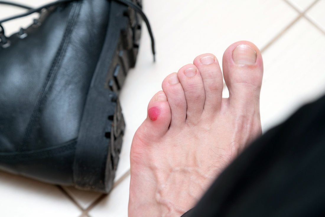 Blister treatment: How to get rid of a blister