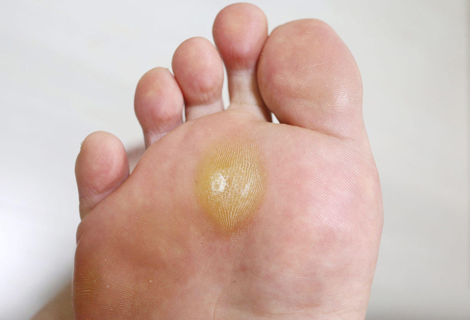 What causes corns on your feet?