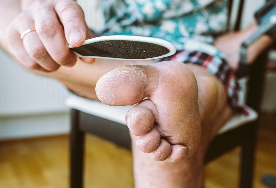 How to get rid of corns