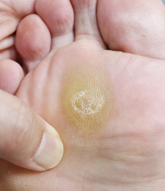Complete Guide to Corn and Callus Treatment