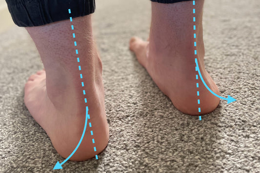 What is overpronation?