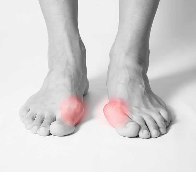 Bunions – ZeroSole